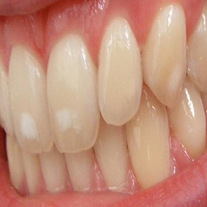 علت لکه‌های سفید دندانی چیست؟