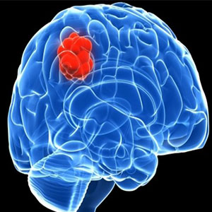 تومور مغزی سیستم ایمنی را تغییر می دهد