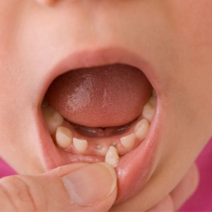 عوامل افتادن دندان کودکان زیر دو سال