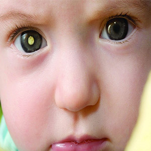 شایع ترین سرطان چشم کودکان