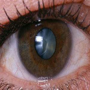 آب مروارید یکی از عمده ترین دلایل اختلال در بینایی است