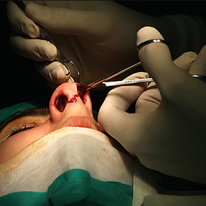 ۶۰ تا ۷۰ درصد مراجعه‌کنندگان برای جراحی بینی نیاز به جراحی ندارند