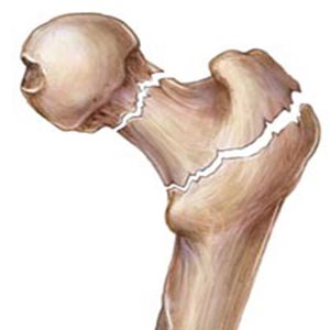 پوکی استخوان بیماری شایع در زنان بالای ۵۰ سال