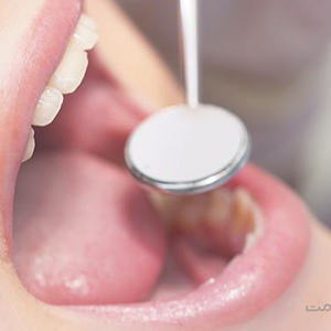 مهمترین علامت سرطان دهان