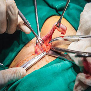 جراحی، درمانِ مناسب برای آپاندیسیت است