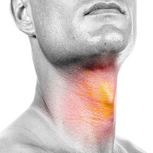 گرفتگی صدا یکی از شایع ترین نشانه های سرطان حنجره