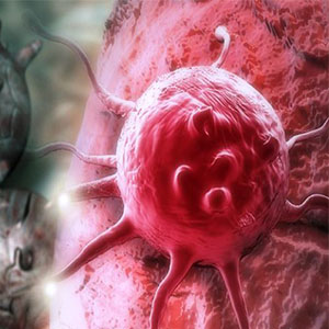 شایع ترین سرطان های جهان در بین مردان