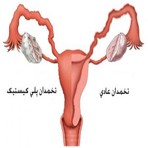 سندروم تخمدان پلی کیستیک برای زنان میانسال مشکل ساز است