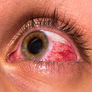عفونت چشم از علت تا درمان