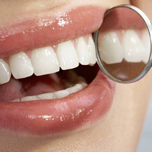 انجام لمینت باعث از بین رفتن کامل مینای دندان نمی‌شود