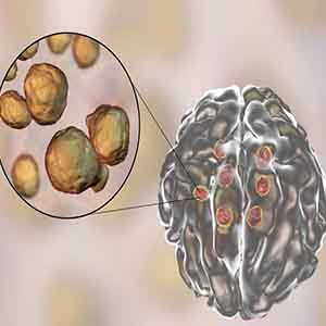 عفونت قارچی در مغز منجر به اختلال حافظه می شود