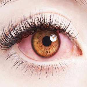 این علایم در چشم ها نشانه چیست؟