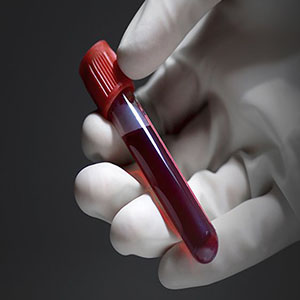 تشخیص زودهنگام سرطان ریه با آزمایش خون