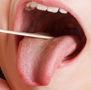 رابطه باکتری دهان و تهاجم سرطان کولورکتال