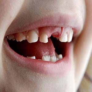 حفاظت از دندان‌های شیری کودکان باید جدی گرفته شود