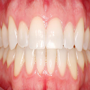 آسیبی که سفیدکننده‌های دندان به‌جا می‌گذارند