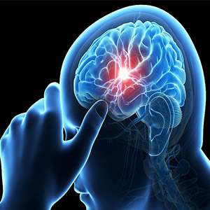نجات بیماران سکته مغزی به کمک درمان مداخله‌ای/ حفظ سلامت بیمار تا ۲۴ ساعت