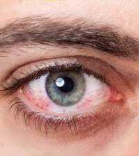 آلرژی های چشمی را خود درمانی نکنید