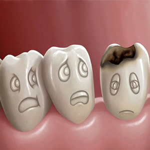 هر کودک 12 ساله ایرانی حداقل 2 دندان خراب دارد
