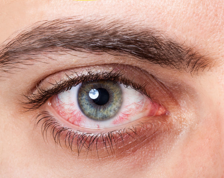 دو علت اصلی خشکی چشم