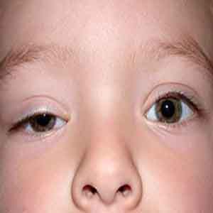 علل افتادگی پلک در کودکان