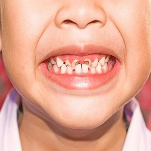 پوسیدگی دندان شایع‌ترین بیماری میکروبی در کودکان