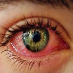 اگر این مشکلات را دارید بیماری چشمی در کمین شماست