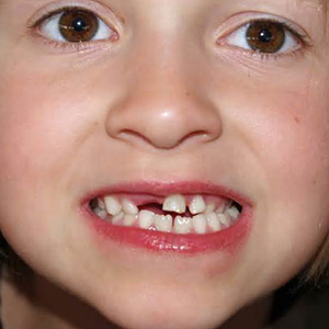 کشیدن دندان‌های شیری کودکان بدون توجیه مشکل ساز می‌شود