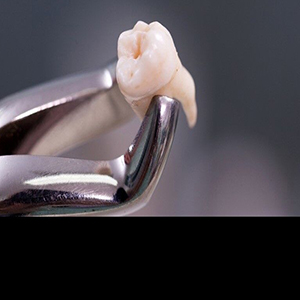 فقط یکساعت فرصت برای کاشت دوباره دندان کنده شده وجود دارد