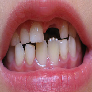 پوسیدگی «دندان شیری» را جدی بگیرید