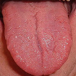 ضایعه کوچک دهانی که گاهی بسیار خطرناک می‌شود