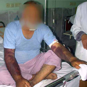ماجرای فوت یک بیمار خوزستانی در اثر تب کریمه کنگو