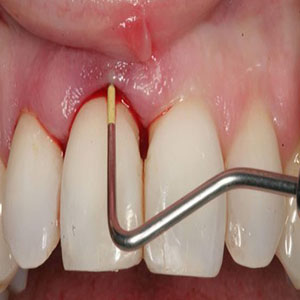 درمان عفونت‌های دندانی با طب سنتی