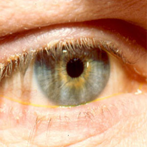 چشم‌ها از کشنده‌ترین بیماری‌ها خبر می‌دهند