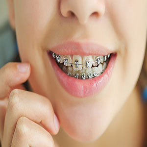 دندان کودکان در چه سنی باید معاینه ارتودنسی شود؟