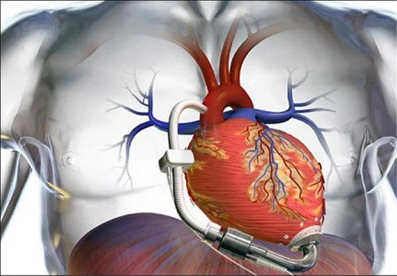 نسخه ای برای کاهش خطر نارسایی قلبی