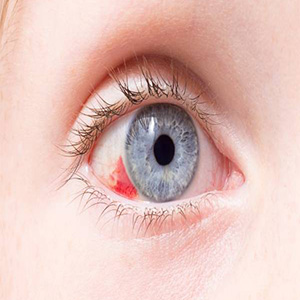 درمان خون ریزی چشم
