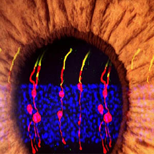 کشف ۴۵ ژن جدید مرتبط با نابینایی