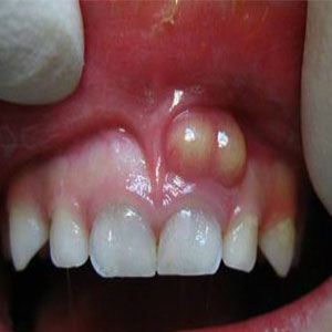 عفونت لثه و دندان چگونه می‌تواند باعث سکته و سرطان شود