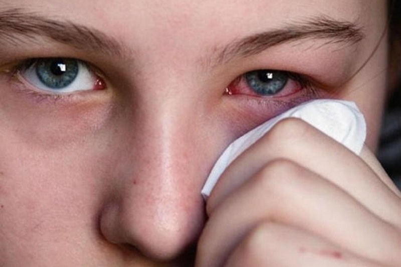 شیوع عفونت‌های ویروسی چشم