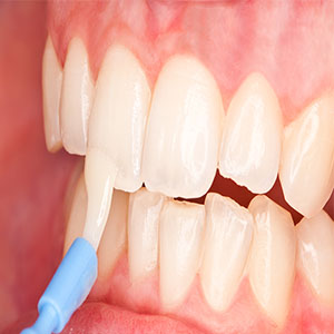 فلوراید بیش از حد موجب پوسیدگی مینای دندان می‌شود