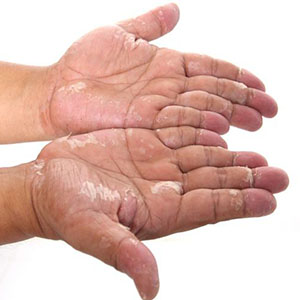 درمان‌های خانگی برای خشکی پوست
