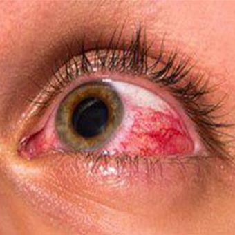 ویروس کرونا می‌تواند باعث درد و قرمزی چشم شود