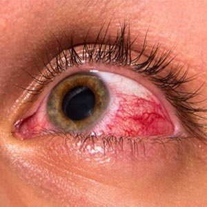 مبتلایان به بیماری‌های چشم درمان را جدی بگیرند