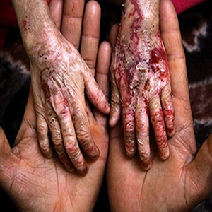 "بیماران پروانه‌ای" از کرونا در امان ماندند/ موارد ابتلا به تعداد انگشتان دست است