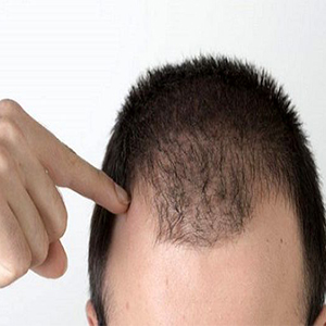 روش ساخت یک ترکیب گیاهی ساده برای جلوگیری از "ریزش مو"