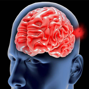 نشانه‌های ابتلا به «آنوریسم مغزی»/ خطر مرگ در کمین مبتلایان