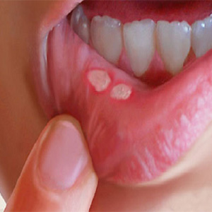 ترفندهای خانگی برای درمان آفت دهان