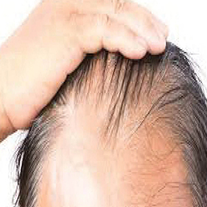 پیشگیری از ریزش موی آقایان‌