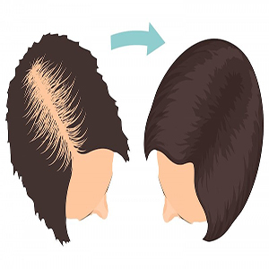 نکات خواندنی درباره کاشت موی زنان
